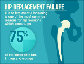 Hip-replacement-failure